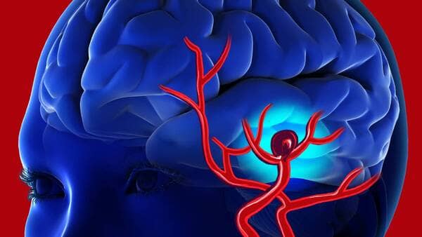 Tratamiento de Aneurisma Cerebral: Prevención y Manejo de Hemorragias