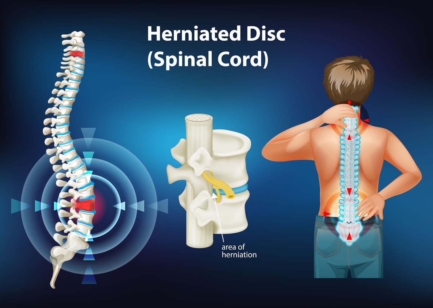 Tratamiento de Hernias de Disco: Alivio para el Dolor de Columna