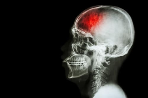 Atención y Tratamiento de Traumatismo Craneoencefálico: Intervención Urgente y Eficaz
