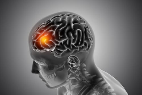 Tratamiento de Tumores Cerebrales: Enfoque Multidisciplinario y Avanzado